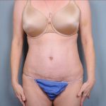 Abdominoplasty Before & After Patient #1896