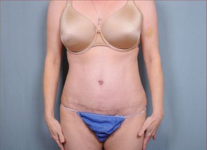 Abdominoplasty Before & After Patient #1896