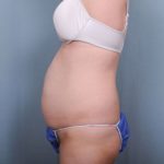 Abdominoplasty Before & After Patient #1896