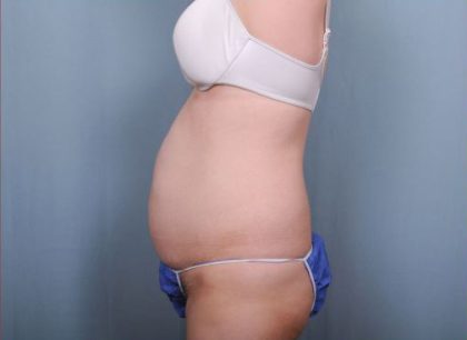 Abdominoplasty Before & After Patient #1896