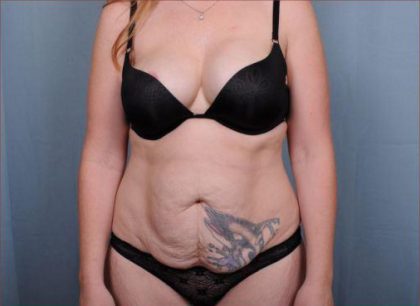 Abdominoplasty Before & After Patient #1895