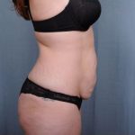 Abdominoplasty Before & After Patient #1895