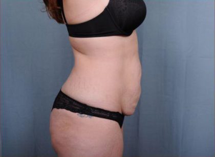 Abdominoplasty Before & After Patient #1895