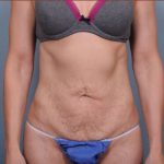 Abdominoplasty Before & After Patient #1894
