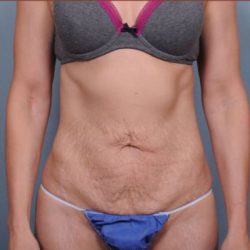 Abdominoplasty Before & After Patient #1894