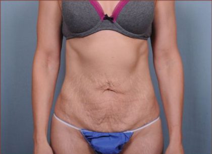 Abdominoplasty Before & After Patient #1894