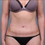 Abdominoplasty Before & After Patient #1894