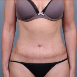 Abdominoplasty Before & After Patient #1894