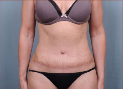 Abdominoplasty Before & After Patient #1894
