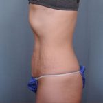 Abdominoplasty Before & After Patient #1894