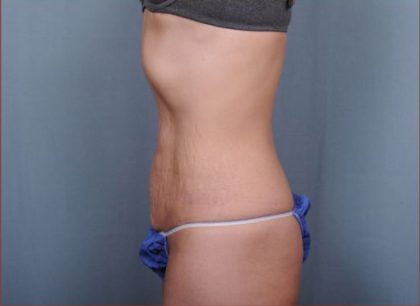 Abdominoplasty Before & After Patient #1894