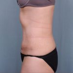 Abdominoplasty Before & After Patient #1894