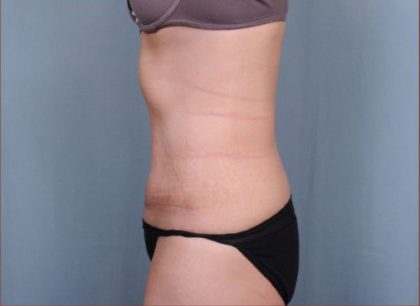 Abdominoplasty Before & After Patient #1894