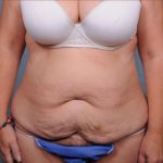 Abdominoplasty Before & After Patient #1893
