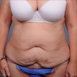 Abdominoplasty Before & After Patient #1893