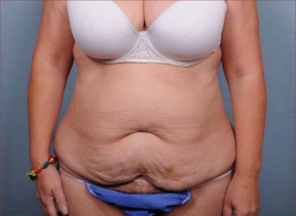 Abdominoplasty Before & After Patient #1893