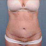 Abdominoplasty Before & After Patient #1893