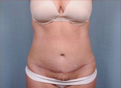 Abdominoplasty Before & After Patient #1893