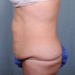 Abdominoplasty Before & After Patient #1893