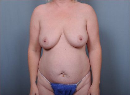 Abdominoplasty Before & After Patient #1908