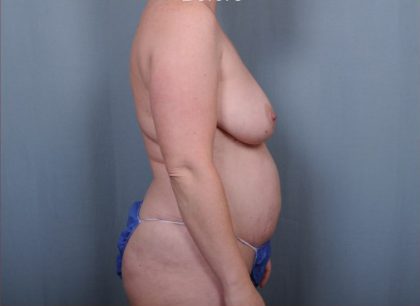 Abdominoplasty Before & After Patient #1908