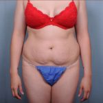 Abdominoplasty Before & After Patient #1907