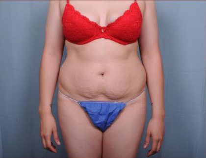 Abdominoplasty Before & After Patient #1907