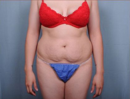 Abdominoplasty Before & After Patient #1907