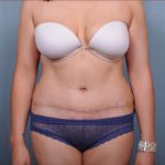 Abdominoplasty Before & After Patient #1907
