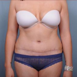 Abdominoplasty Before & After Patient #1907
