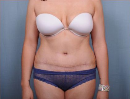 Abdominoplasty Before & After Patient #1907