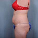 Abdominoplasty Before & After Patient #1907