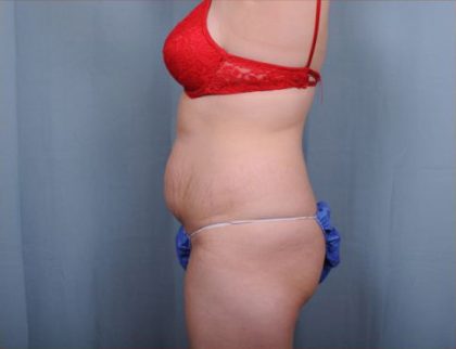 Abdominoplasty Before & After Patient #1907