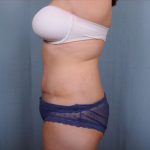 Abdominoplasty Before & After Patient #1907