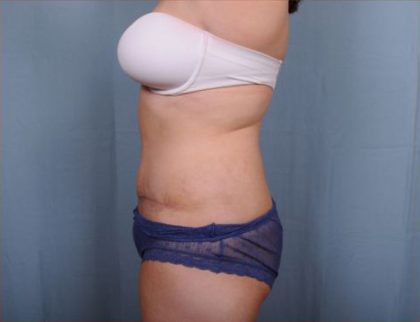 Abdominoplasty Before & After Patient #1907