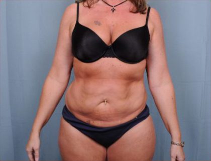 Abdominoplasty Before & After Patient #1906