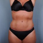Abdominoplasty Before & After Patient #1906