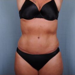 Abdominoplasty Before & After Patient #1906