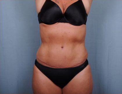 Abdominoplasty Before & After Patient #1906