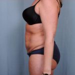 Abdominoplasty Before & After Patient #1906
