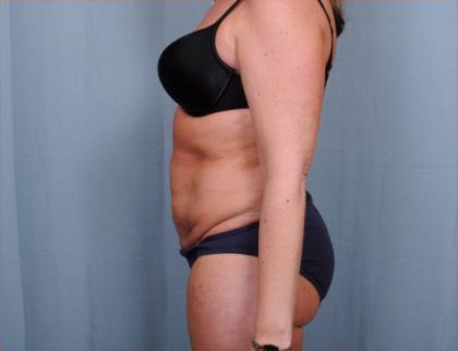 Abdominoplasty Before & After Patient #1906
