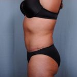 Abdominoplasty Before & After Patient #1906