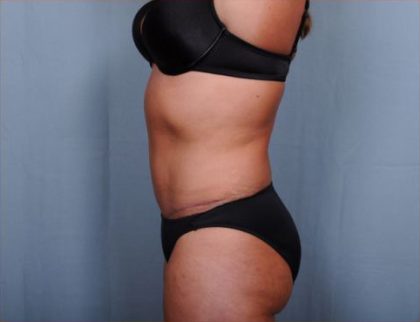 Abdominoplasty Before & After Patient #1906