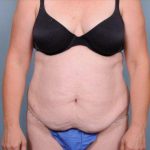 Abdominoplasty Before & After Patient #1905