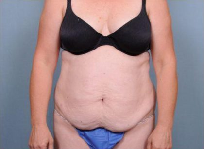 Abdominoplasty Before & After Patient #1905
