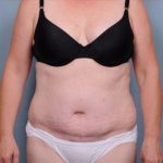 Abdominoplasty Before & After Patient #1905