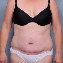 Abdominoplasty Before & After Patient #1905