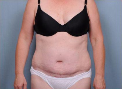 Abdominoplasty Before & After Patient #1905