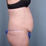 Abdominoplasty Before & After Patient #1905