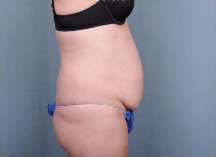 Abdominoplasty Before & After Patient #1905